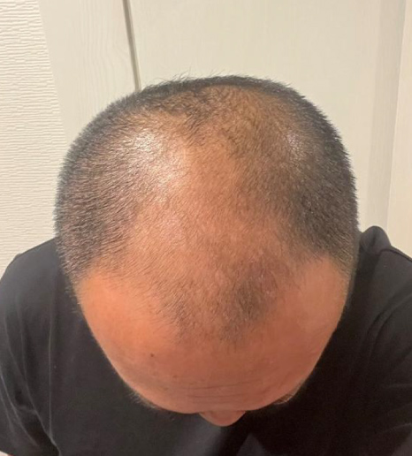Before(治療前)