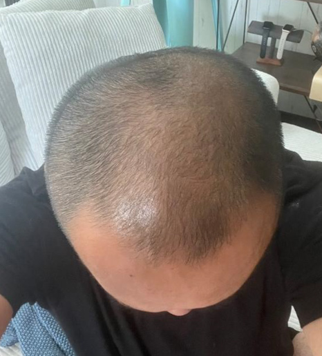 After(3か月後)